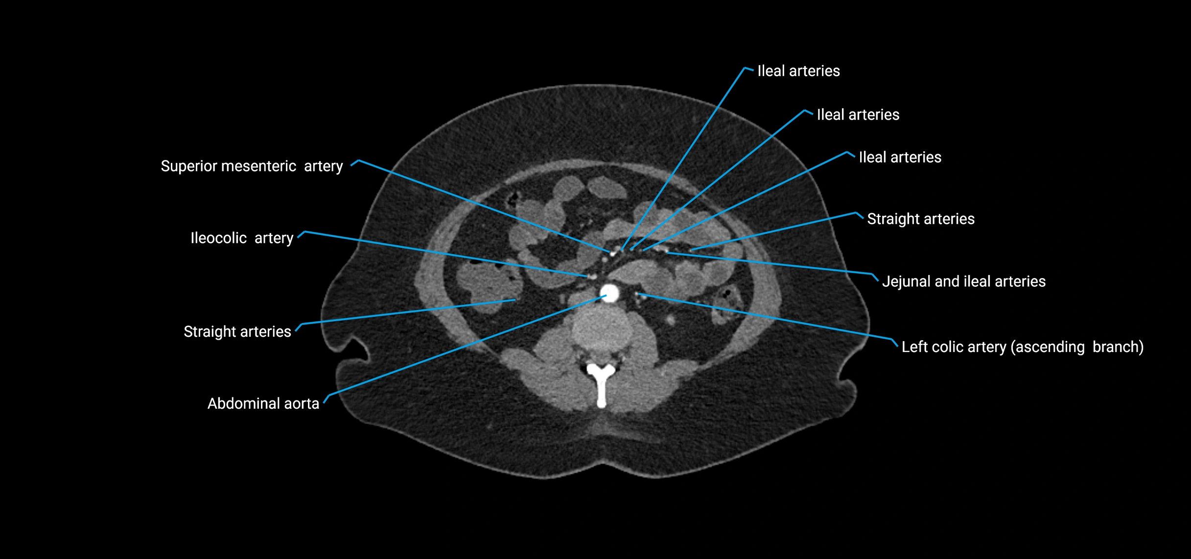 CTA abdomen axial cross sectional anatomy labelled image_104 (2).webp